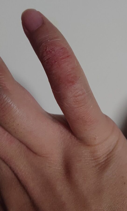 指のひび割れが治らない 微グロ注意 なまてんのブログ